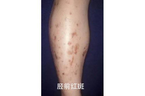 皮肤是人体自带的血糖仪？应急总医院内分泌科主任医师王凯亮介绍说，皮肤作为人体最大的器官，其健康状况往往能直观反映身体内部环境，尤其是血糖水平的异常