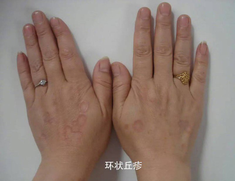 皮肤是人体自带的血糖仪？应急总医院内分泌科主任医师王凯亮介绍说，皮肤作为人体最大的器官，其健康状况往往能直观反映身体内部环境，尤其是血糖水平的异常